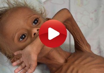 Yemen'de çocuklar açlıktan ölüyor